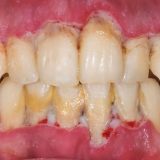 Malattie parodontali: cause, sintomi e cura ad Alghero