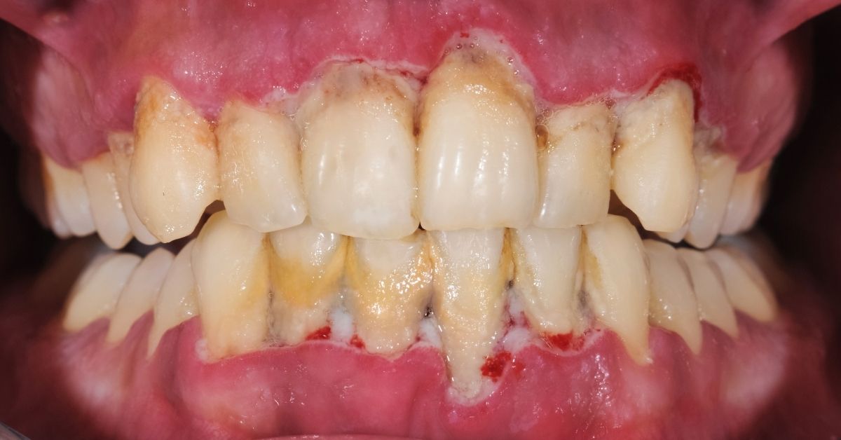 Malattie parodontali: cause, sintomi e cura ad Alghero