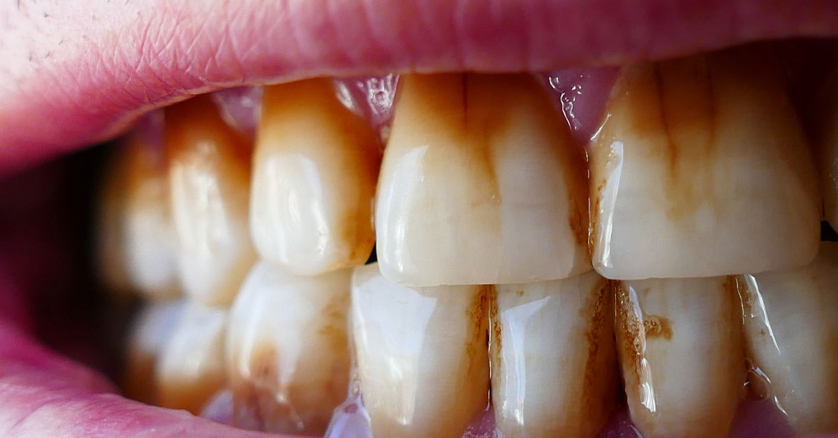 Gli effetti del fumo su denti e gengive: tutto ciò che devi sapere per la salute del tuo cavo orale